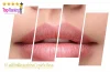 ฟิลเลอร์ปาก-cupids-bow